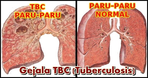 Merupakan bakteri menyebabkan plasmodium penyakit yang tuberculosis TBC (Tuberkulosis)